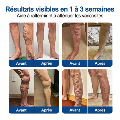 Patch Anti-Varices